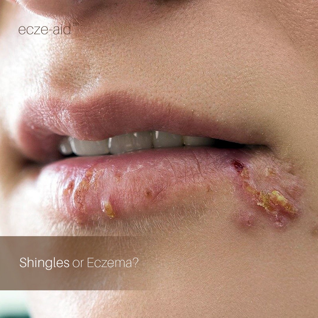 You are currently viewing Shingles vs. Eczema: What’s The Differentiate?