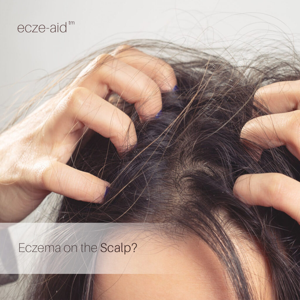 Is It Scalp Eczema or Dandruff?